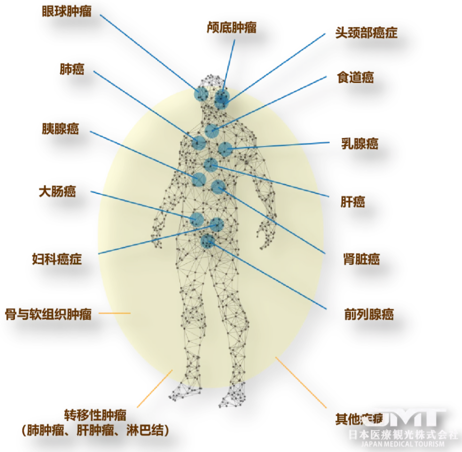 日本肿瘤治疗尖端技术说明